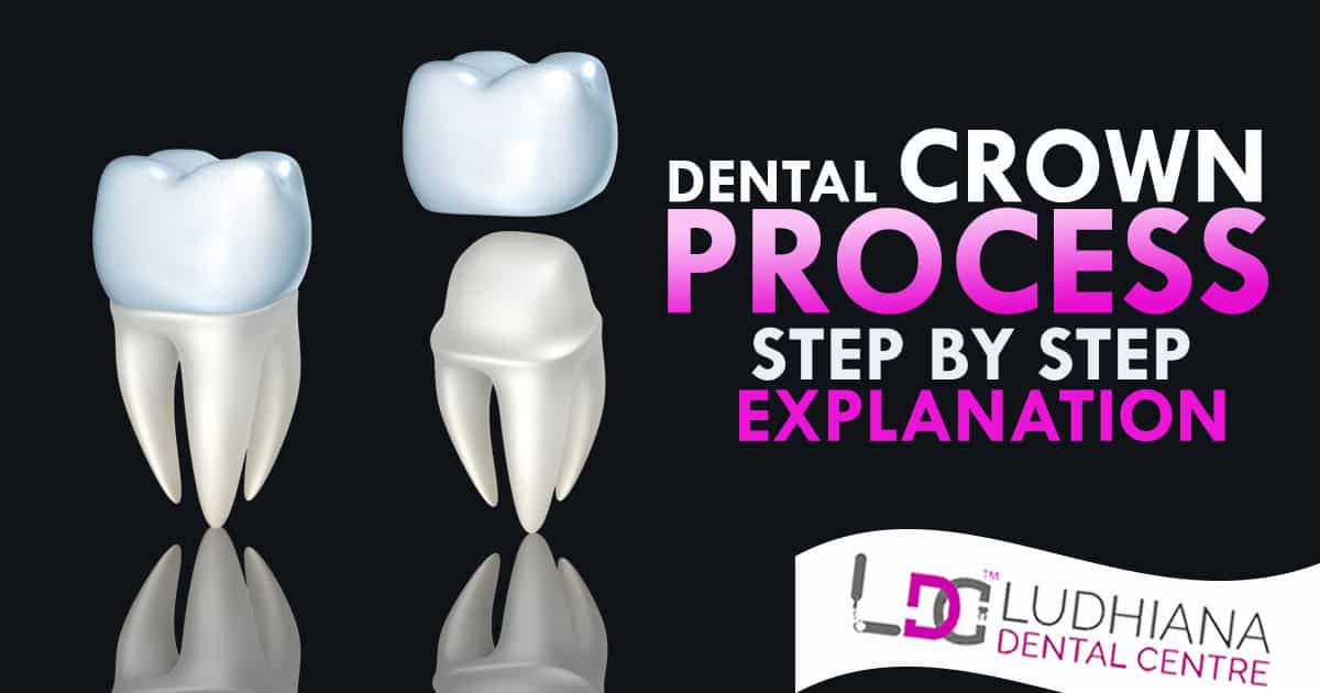 Porcelain dental crown restoration process diagram for smile enhancement.