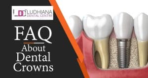 Dental implant with crown at Ludhiana Dental Centre, expert in dental crowns and restoration services.