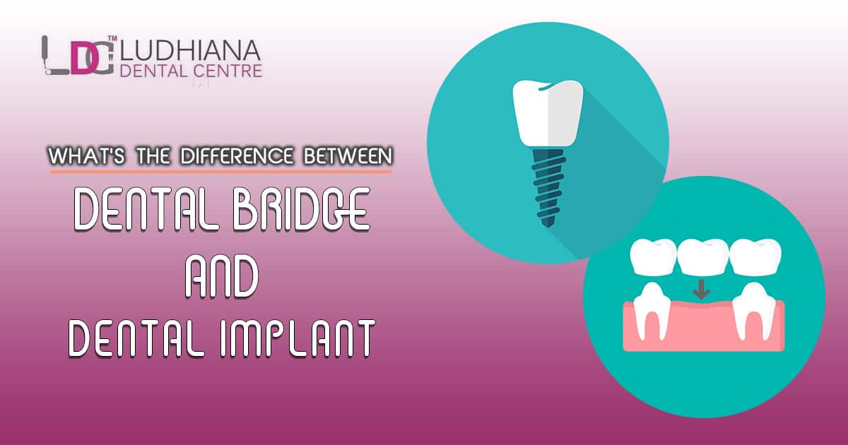 Dental bridge versus dental implant comparison at Ludhiana Dental Centre.
