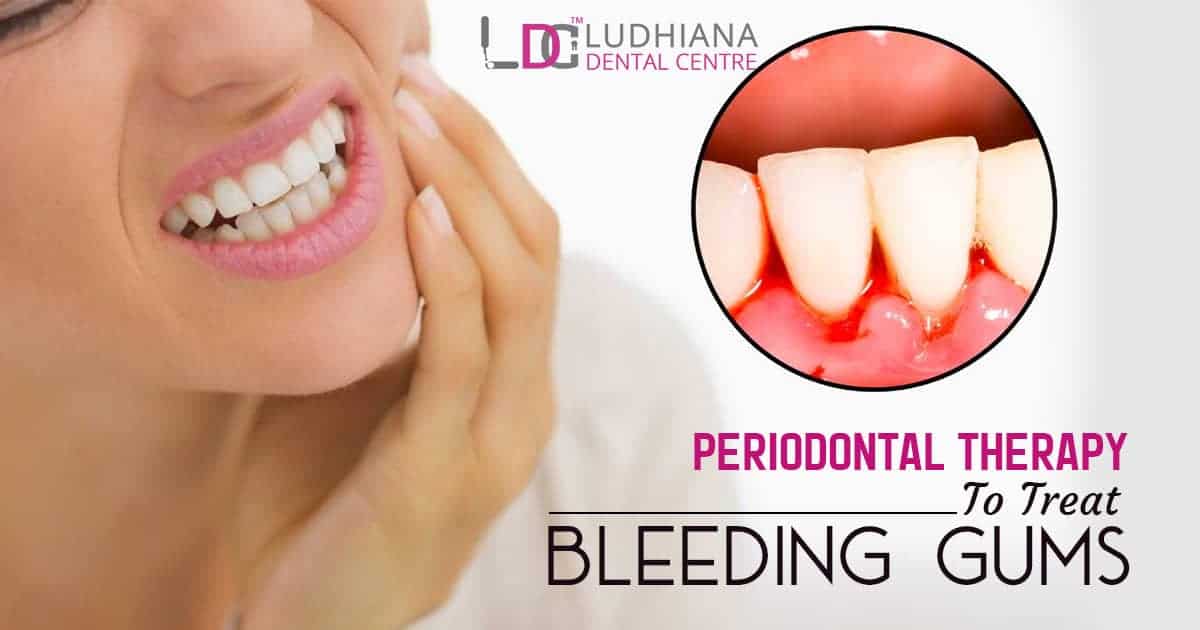 Healthy teeth and gums with periodontal therapy for bleeding gums at Ludhiana Dental Centre.