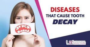 Tooth decay diseases causing dental problems in Ludhiana Dental Centre.
