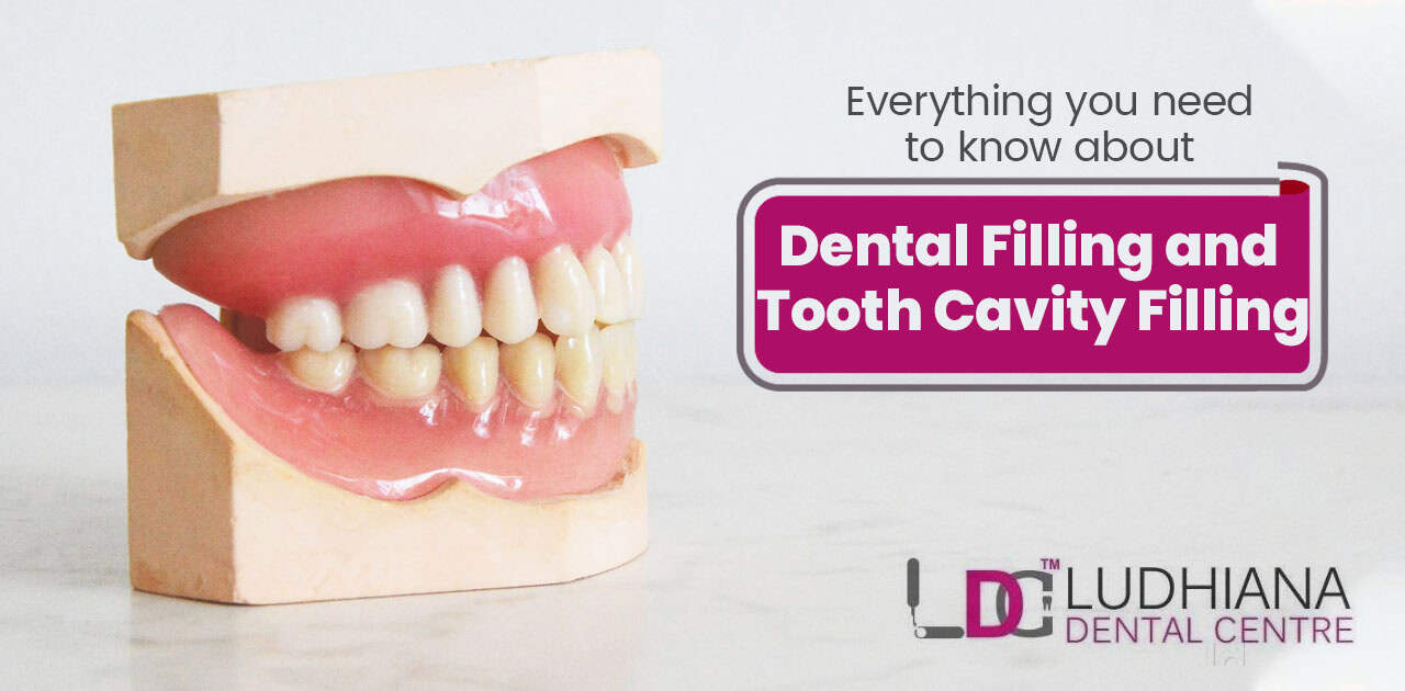 Close-up of dental model showing tooth cavity filling and dental restoration procedures.