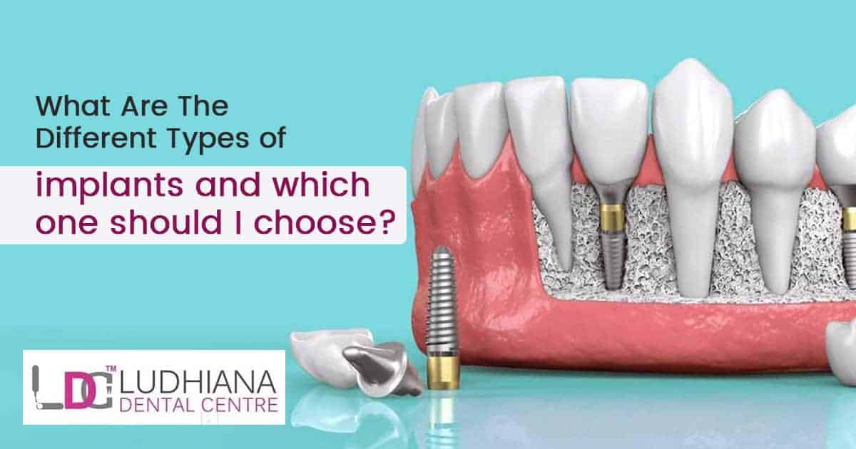 Dental implant types and selection guide at Ludhiana Dental Centre. Expert dental care for your smile.