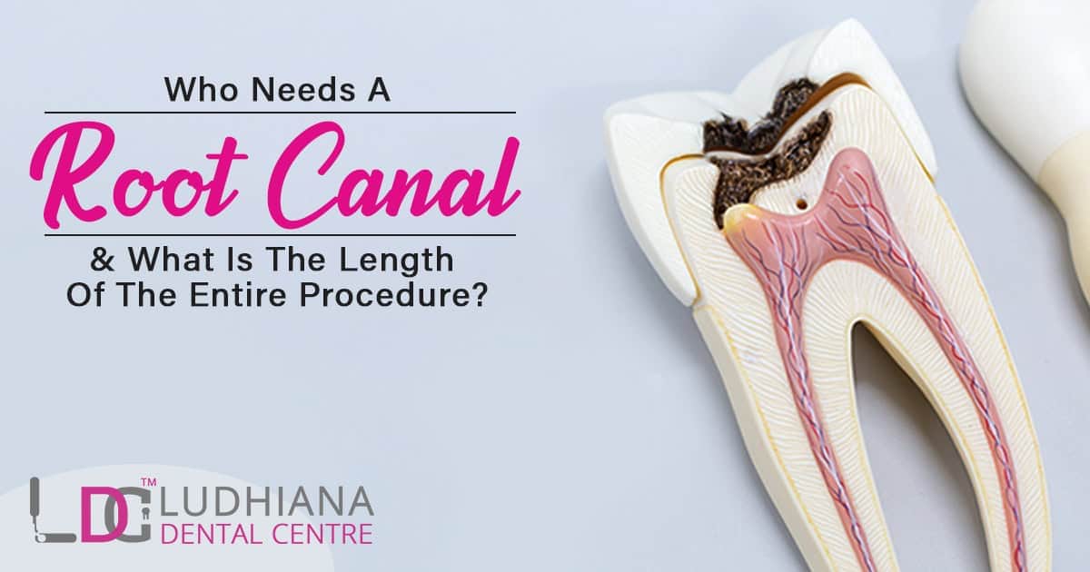 Root canal treatment in Ludhiana Dental Centre for tooth decay and root infections. Expert dental care in Ludhiana.
