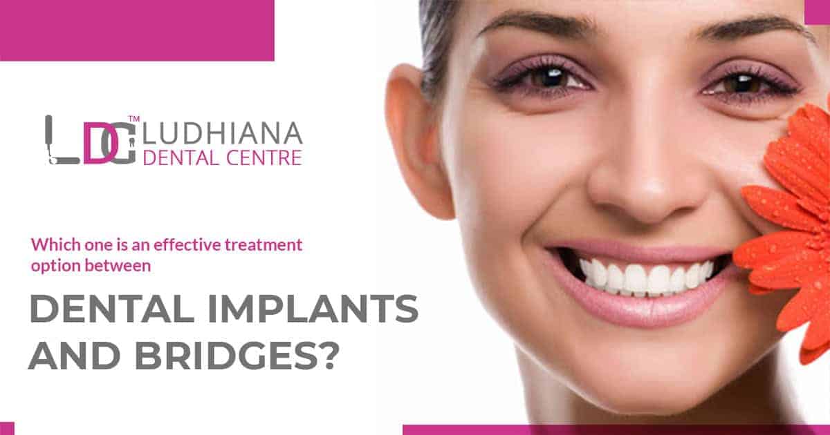 Dental implants and bridges at Ludhiana Dental Centre for effective tooth restoration solutions.