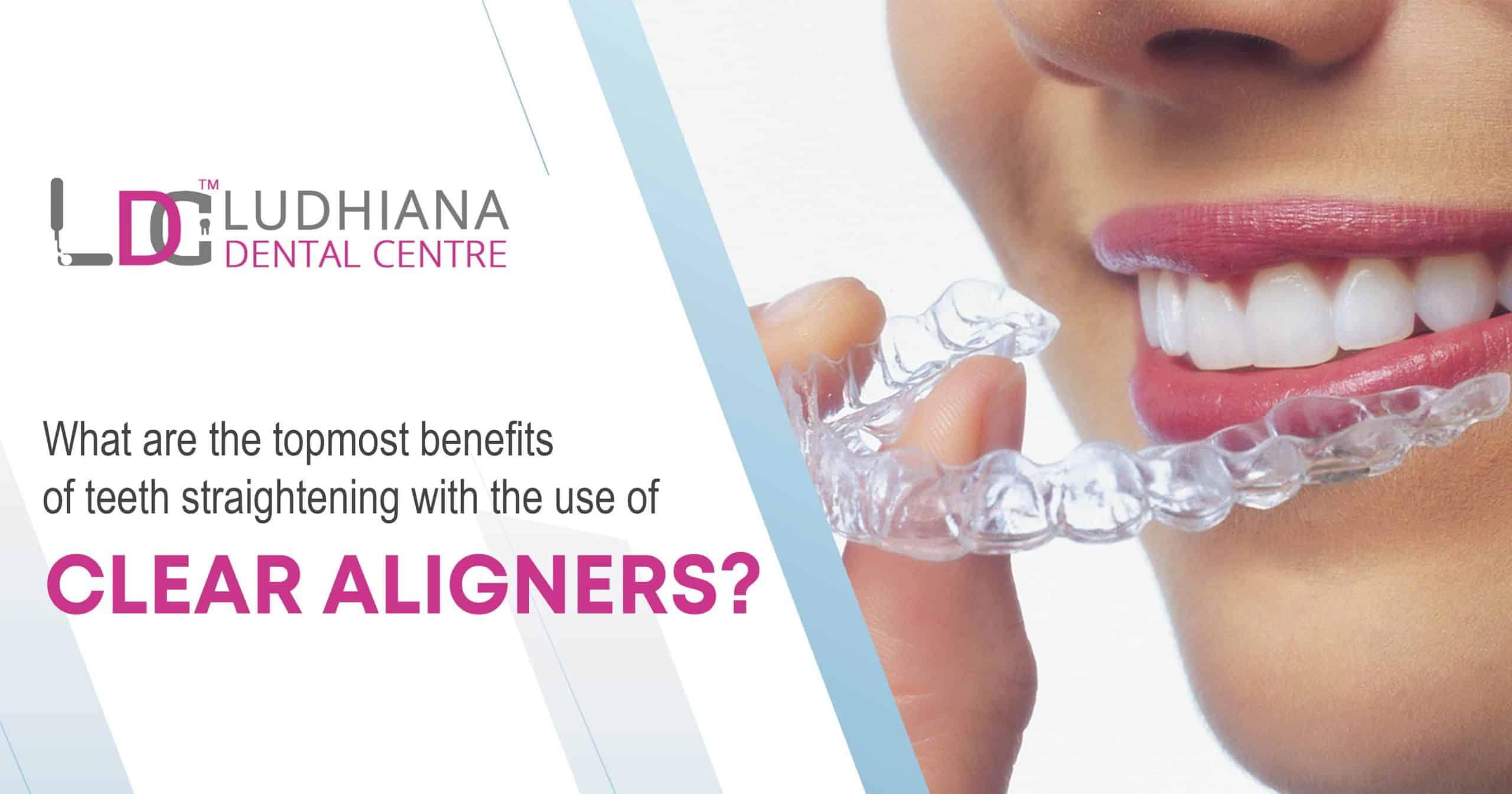 Clear teeth straightening with Invisalign at Ludhiana Dental Centre.