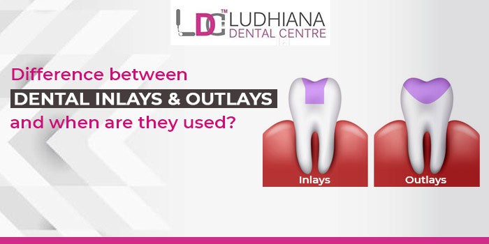 Inlays vs Outlays dental treatment options explained at Ludhiana Dental Centre.