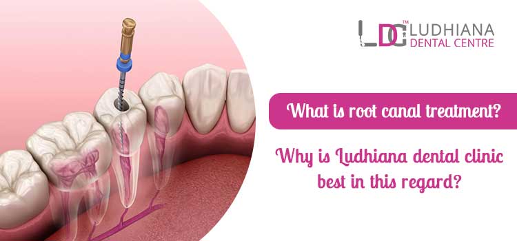 What is root canal treatment? Why is Ludhiana dental clinic best in this regard?