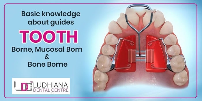 Tooth extraction guide for Borne, Mucosal, and Bone Borne teeth | Ludhiana Dental Centre.