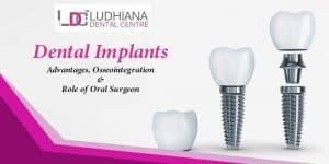 Dental implants in Ludhiana for improved oral health and confidence. Expert osseointegration and oral surgeon services.