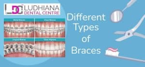 Metal, clear, lingual, and clear aligner braces for optimal dental care in Ludhiana.