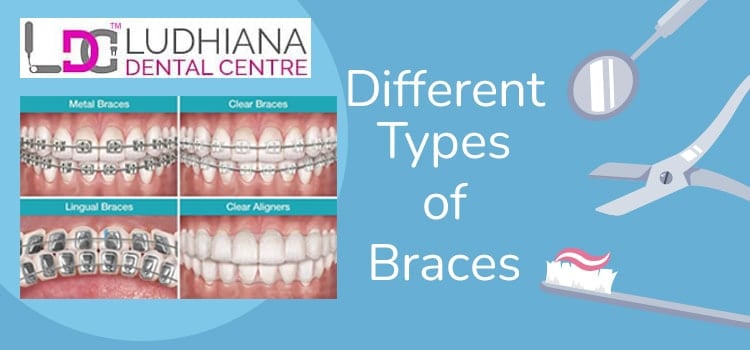 Metal, clear, lingual, and clear aligner braces for optimal dental care in Ludhiana.