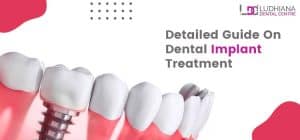 Dental implant treatment in Ludhiana | Ludhiana Dental Centre.