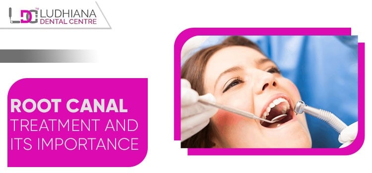 Root canal treatment at Ludhiana Dental Centre for pain relief and oral health care.