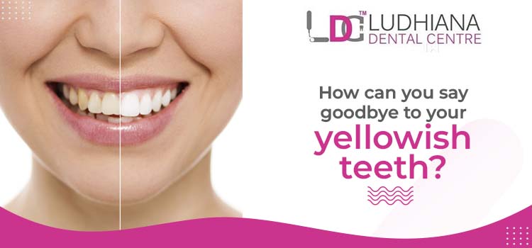 Vanish yellow teeth with expert dental whitening services at Ludhiana Dental Centre.