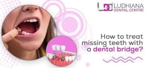 Missing teeth treatment with dental bridges at Ludhiana Dental Centre, professional dental care in Ludhiana.