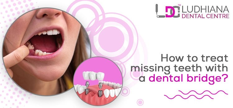 Missing teeth treatment with dental bridges at Ludhiana Dental Centre, professional dental care in Ludhiana.