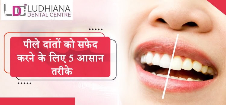 पीले-दांतों-को-सफेद-करने-के-लिए-5-आसान-तरीके