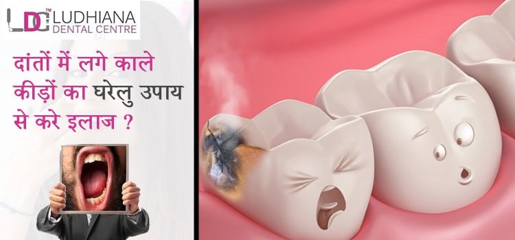 दांतों-में-लगे-काले-कीड़ों-का-घरेलु-उपाय-से-करे-इलाज