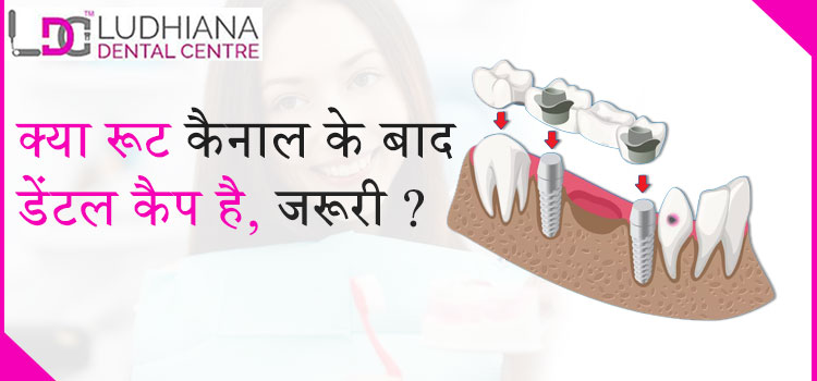 क्या रूट कैनाल के बाद डेंटल कैप है, जरूरी ?
