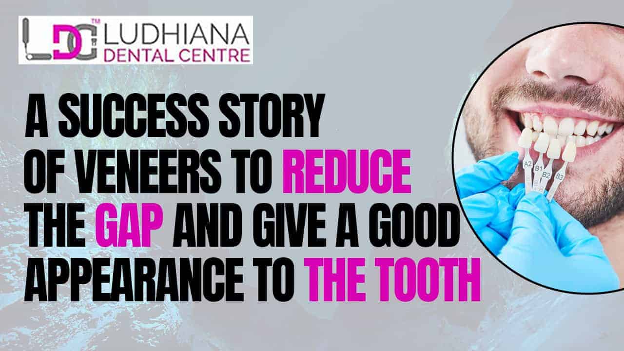 Veneers for teeth whitening at Ludhiana Dental Centre, affordable and effective cosmetic dentistry.