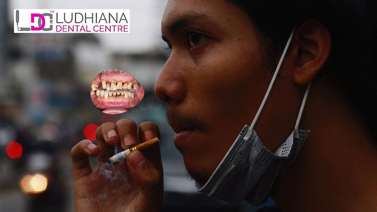 Smoking and Oral Health Understanding the Risks and How to Protect Your Smile