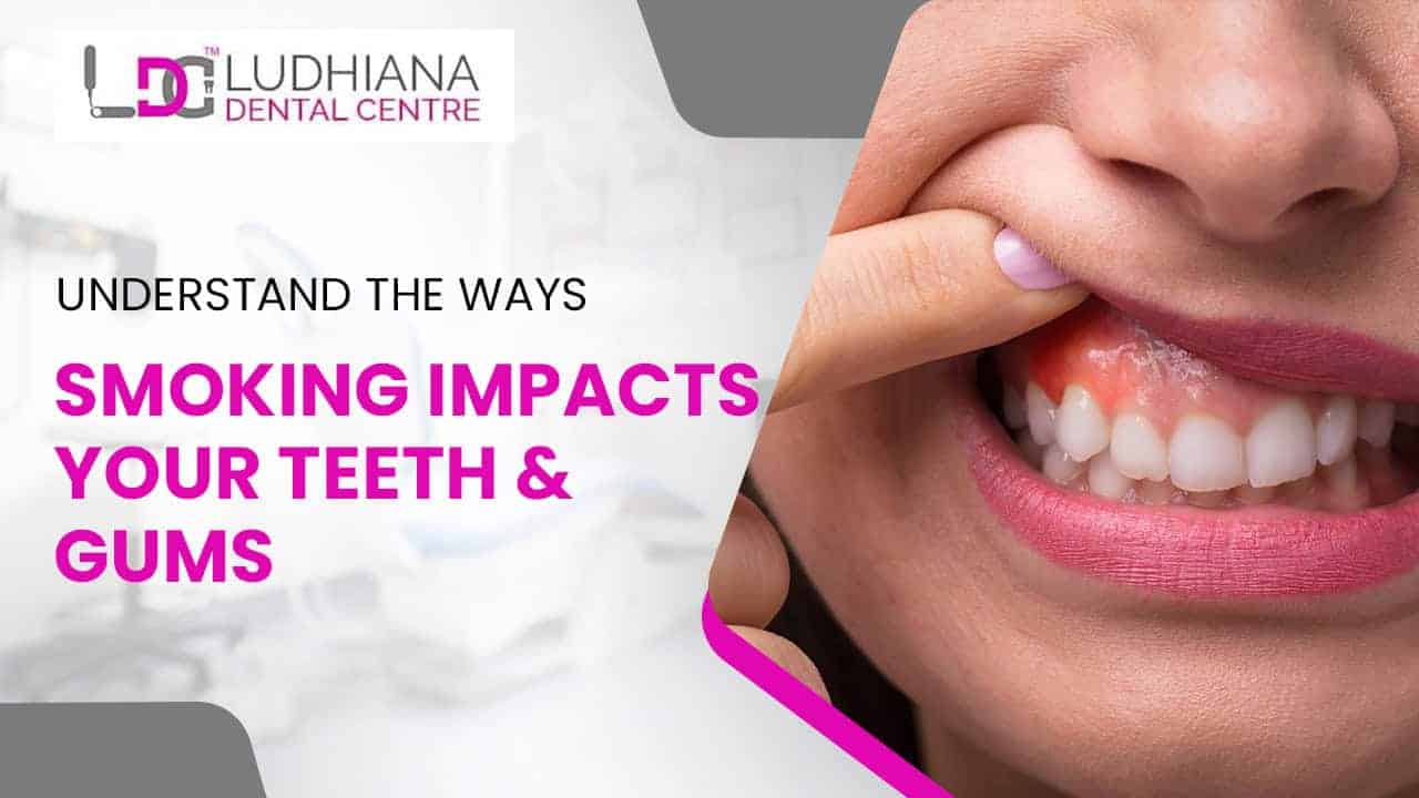 Damaged teeth and gums due to smoking, Ludhiana Dental Centre.