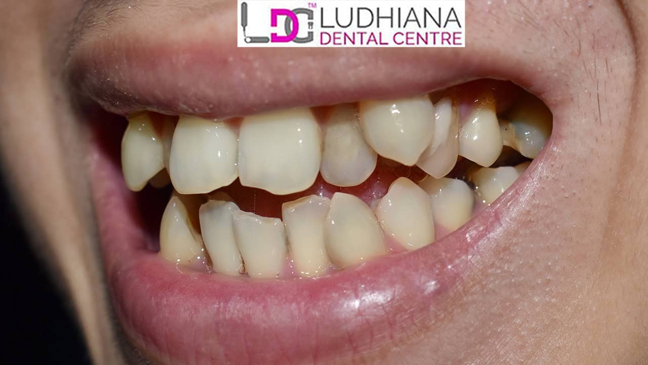 Why Teeth Whitening is Essential: Factors That Cause Yellow Teeth