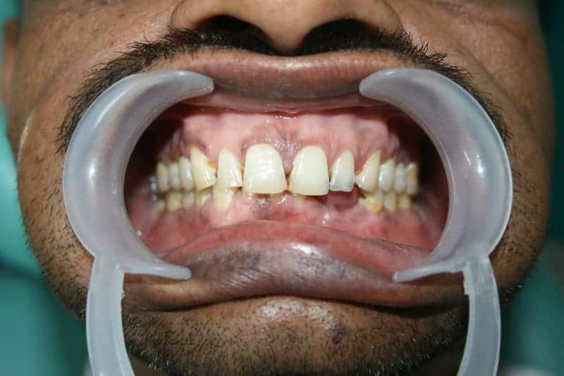 Crooked and damaged teeth treatment Ludhiana Dental Centre.