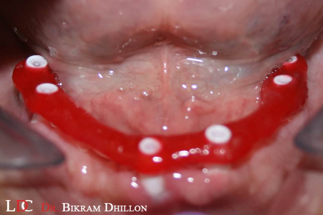 Clear dental implant placement in lower jaw at Ludhiana Dental Centre.