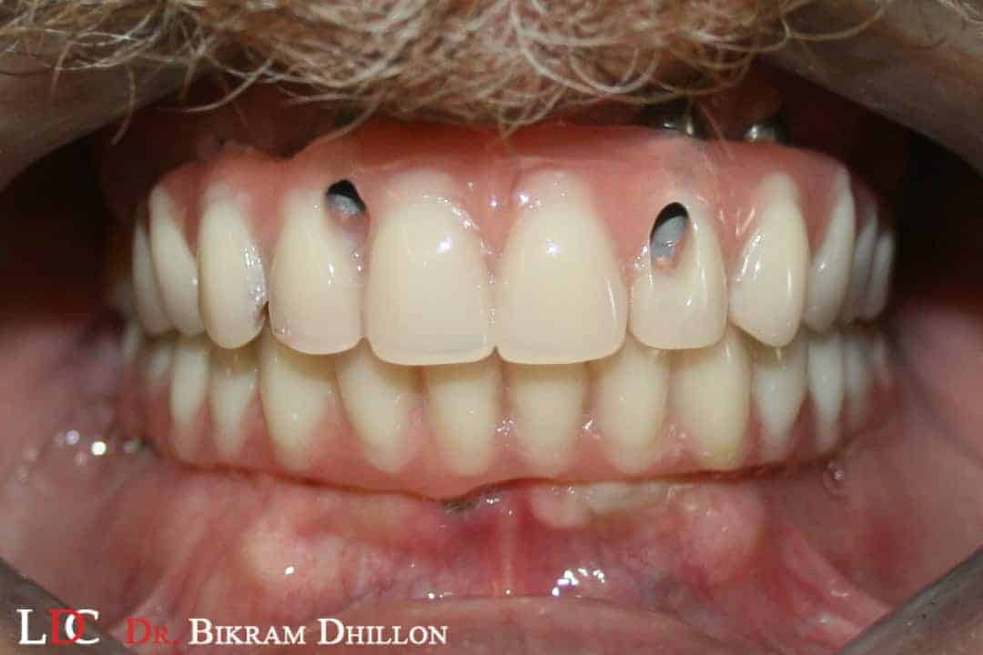 Missing upper front teeth with dental implants made of high-quality materials.