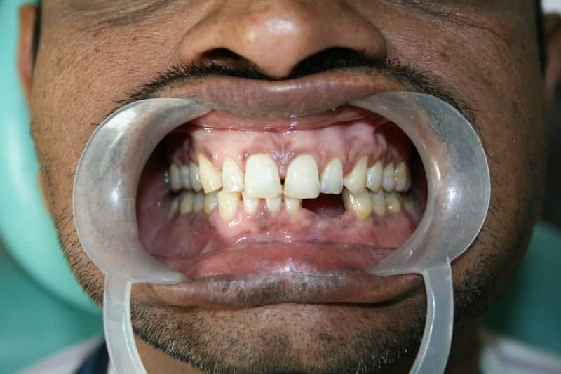 Damaged teeth and cavities in patient's mouth at Ludhiana Dental Centre.