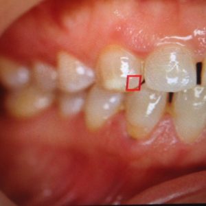 Damaged tooth decay dental cavity photo, Ludhiana Dental Centre.