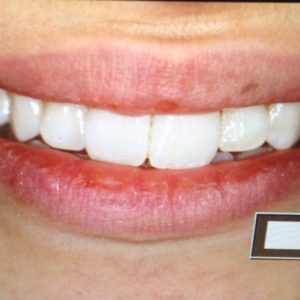 Veneers and dental smile makeover at Ludhiana Dental Centre.