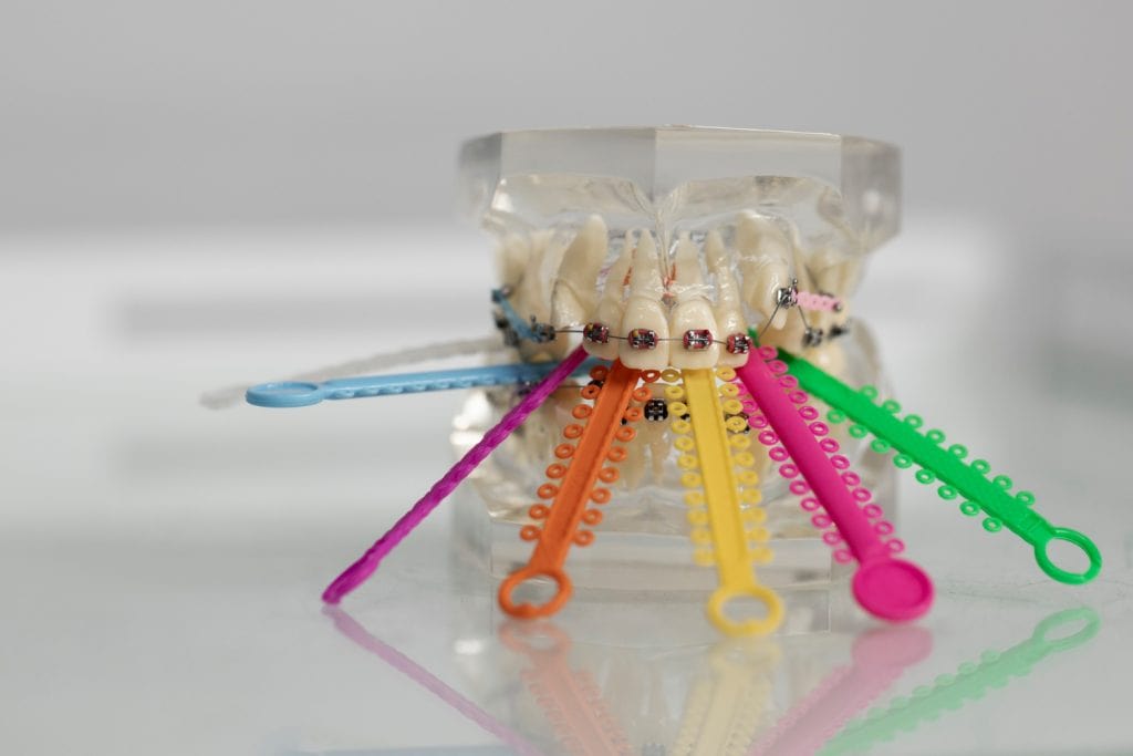 Colorful orthodontic braces on dental model for teeth alignment and braces treatment at Ludhiana Dental Centre.