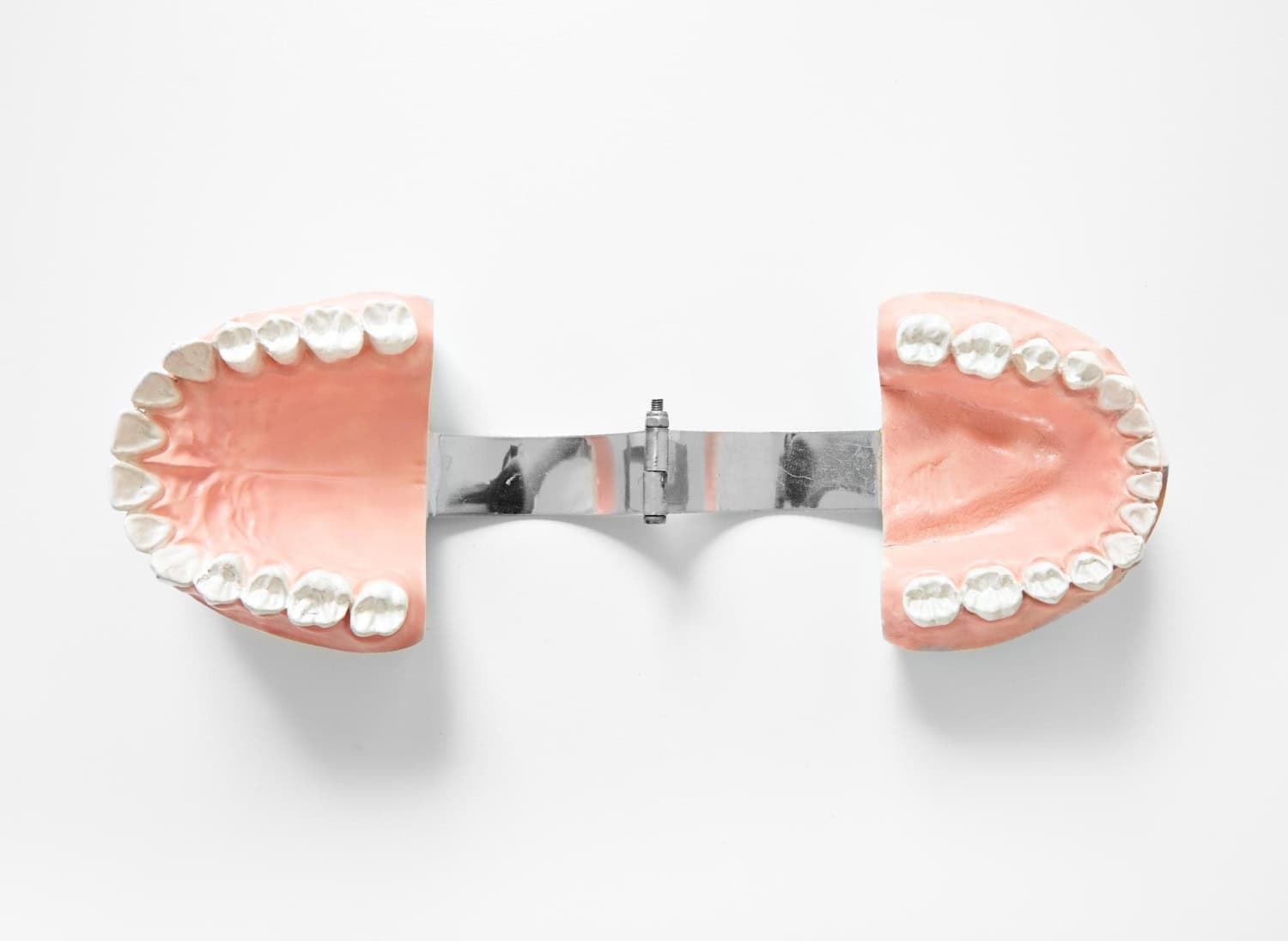 Dental model with implant bridge for advanced dental restorations in Ludhiana.