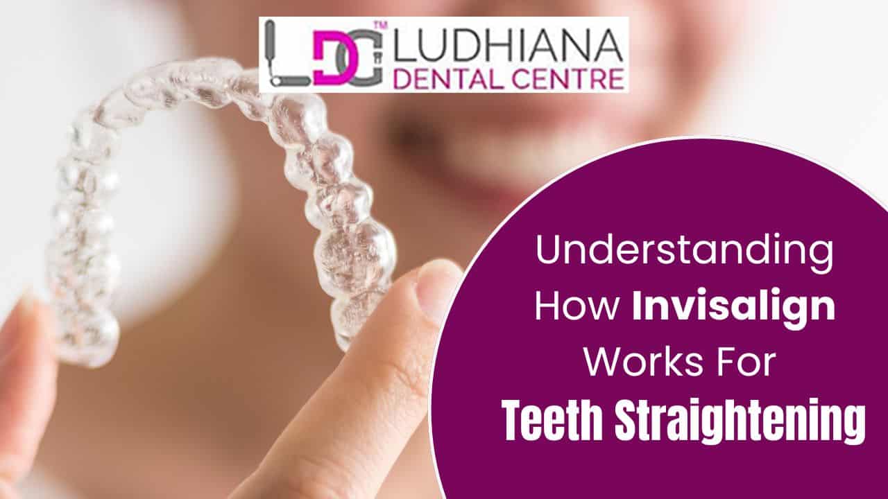 Clear aligners for teeth straightening at Ludhiana Dental Centre, experts in Invisalign treatment.