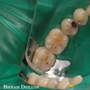 Dental cavity treatment at Ludhiana Dental Centre clean & safe dental care services.