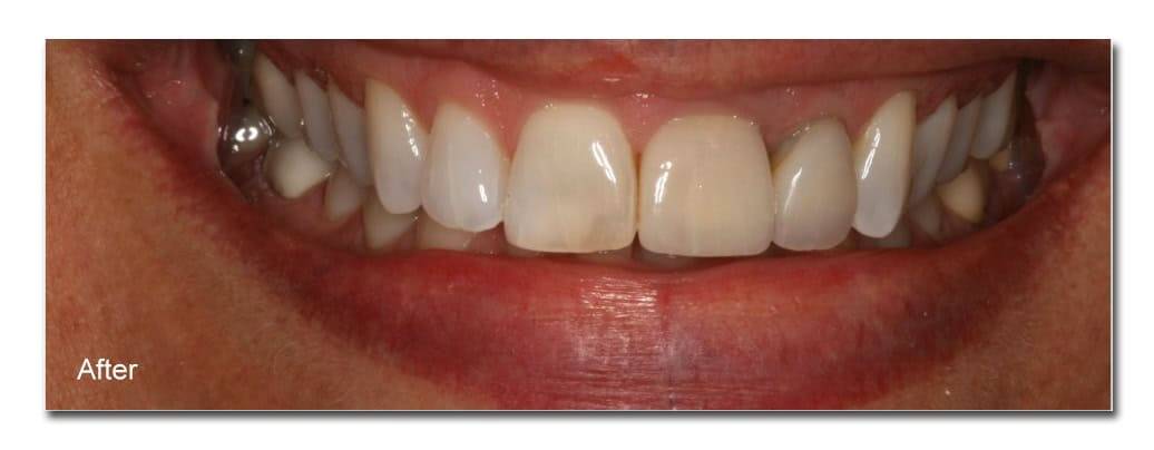 Healthy smile with improved teeth aesthetics after dental treatment at Ludhiana Dental Centre.