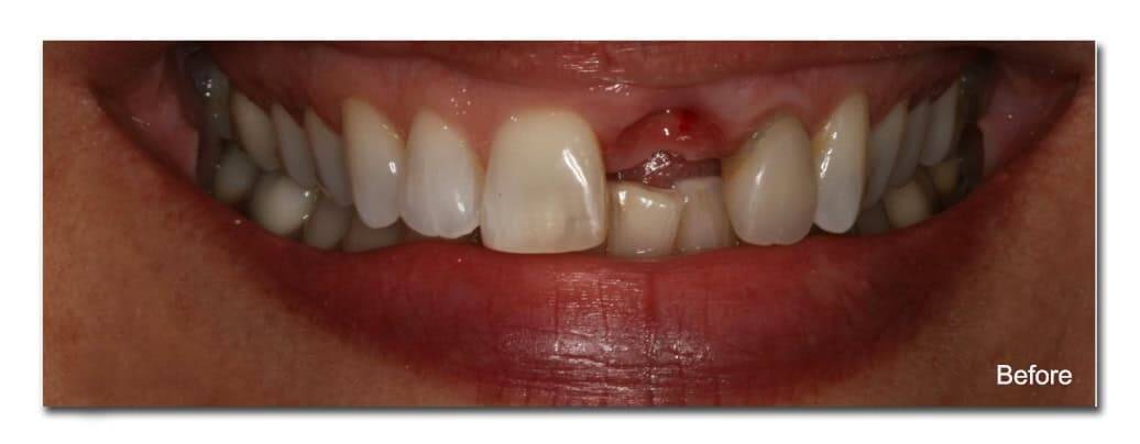 Missing front teeth and gum injury before dental treatment at Ludhiana Dental Centre.