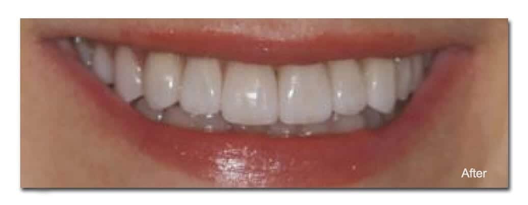Bright white, perfectly aligned teeth after cosmetic dental treatment at Ludhiana Dental Centre.