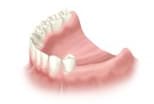 Partial dentures with pink acrylic gum base and artificial teeth for dental restoration.