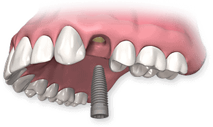 Dental implant with artificial tooth in upper jaw, dental restoration procedure.