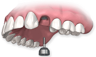 Missing tooth dental implant procedure showing the implant post in Ludhiana.
