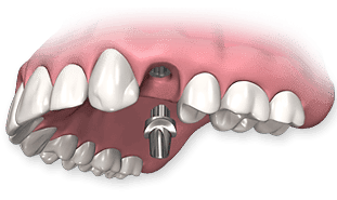Implant-supported dental crown on lower jaw for improved dental restoration.