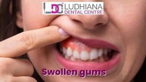 Swollen gums caused by gum infection or inflammation, requiring dental treatment at Ludhiana Dental Centre.