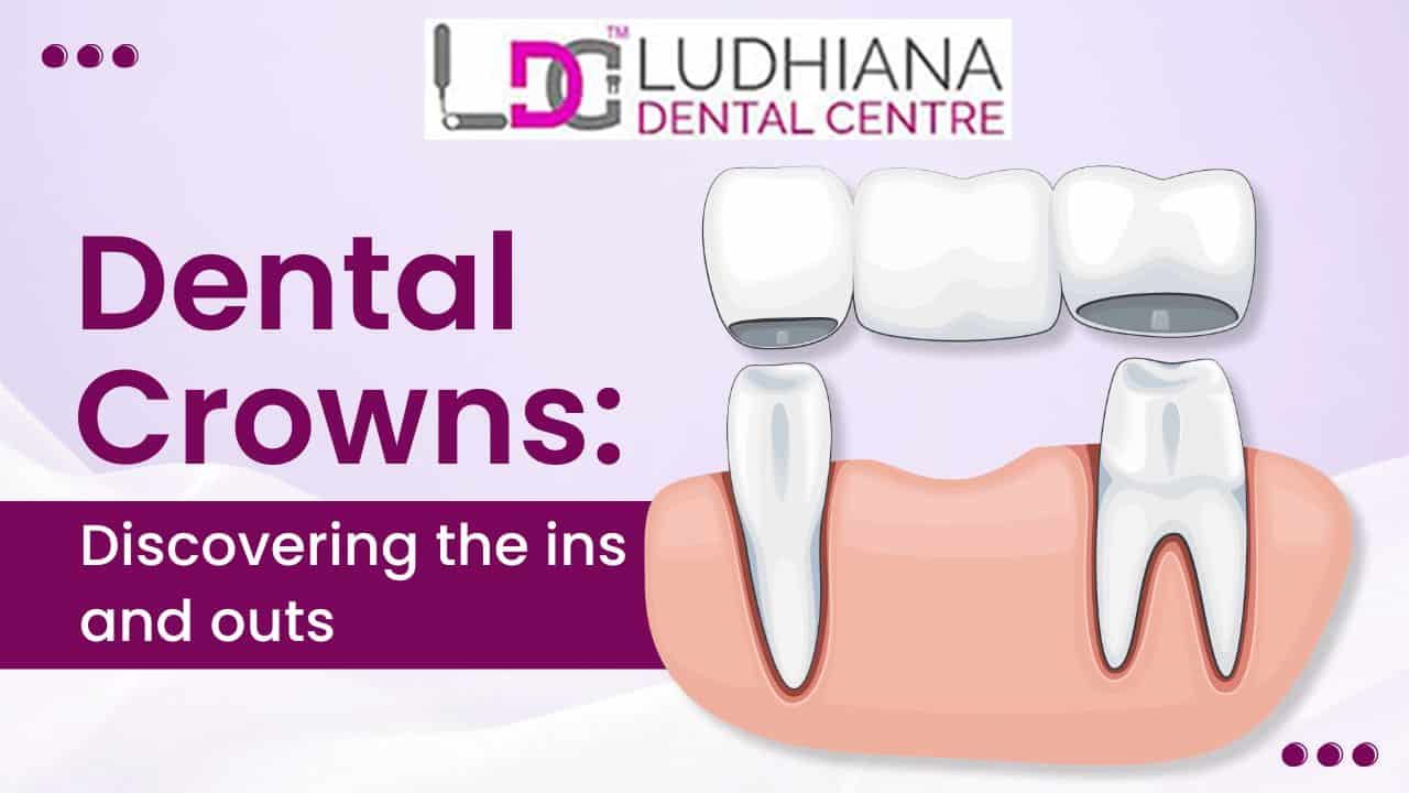 Dental crowns showing the ins and outs for restorative dentistry.