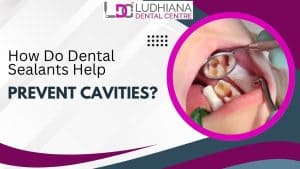 Prevent cavities with dental sealants at Ludhiana Dental Centre for healthy teeth.