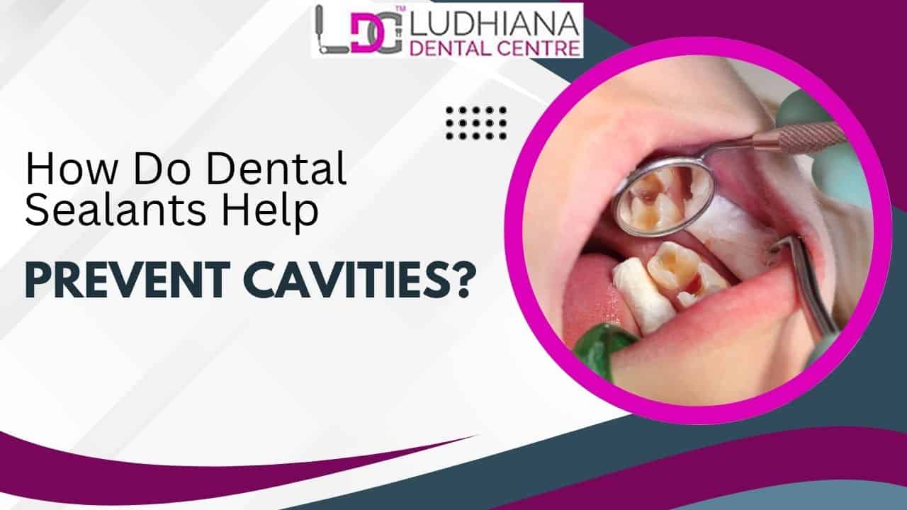Prevent cavities with dental sealants at Ludhiana Dental Centre for healthy teeth.