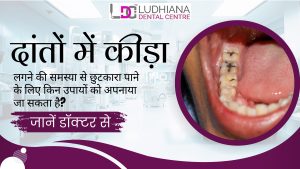 what-measures-can-be-taken-to-get-rid-of-tooth-decay